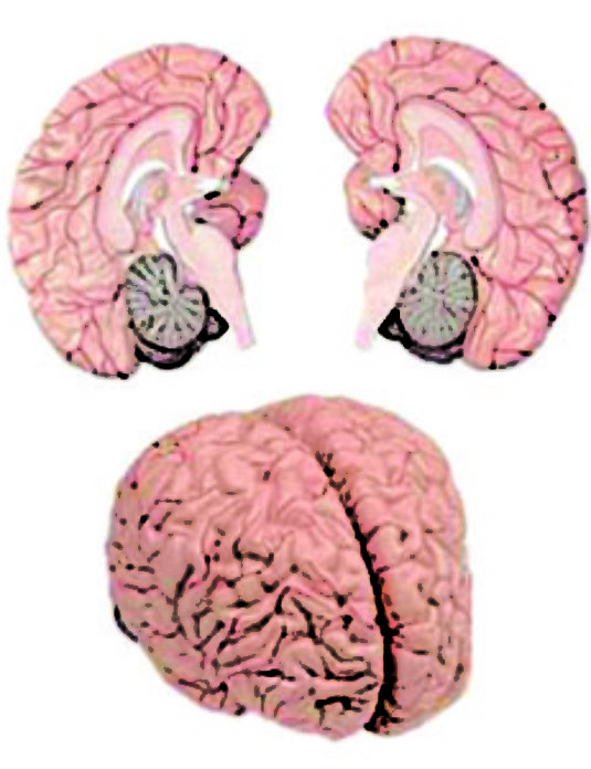Brain-With-Arteries-2-Parts