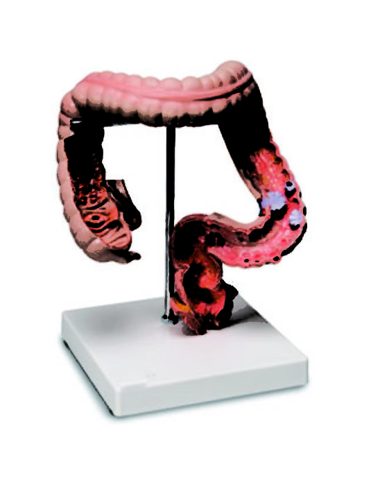 Pathological-Model-Of-Colon-And-Rectum