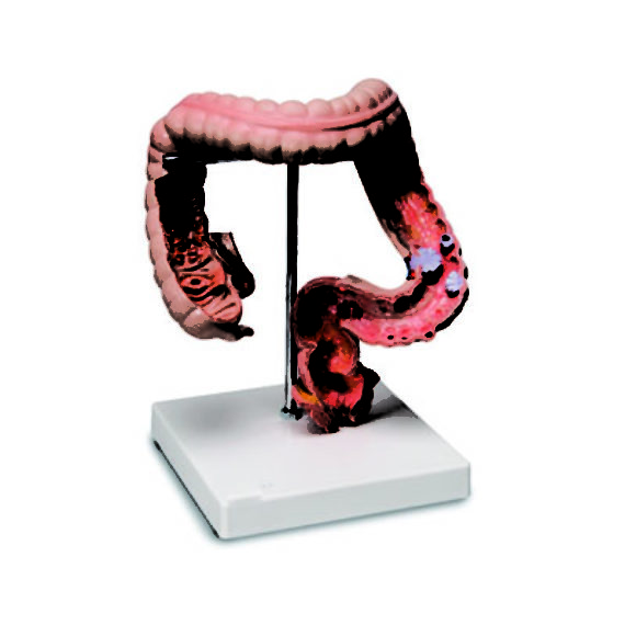 Pathological Model Of Colon And Rectum Biology Diagrams