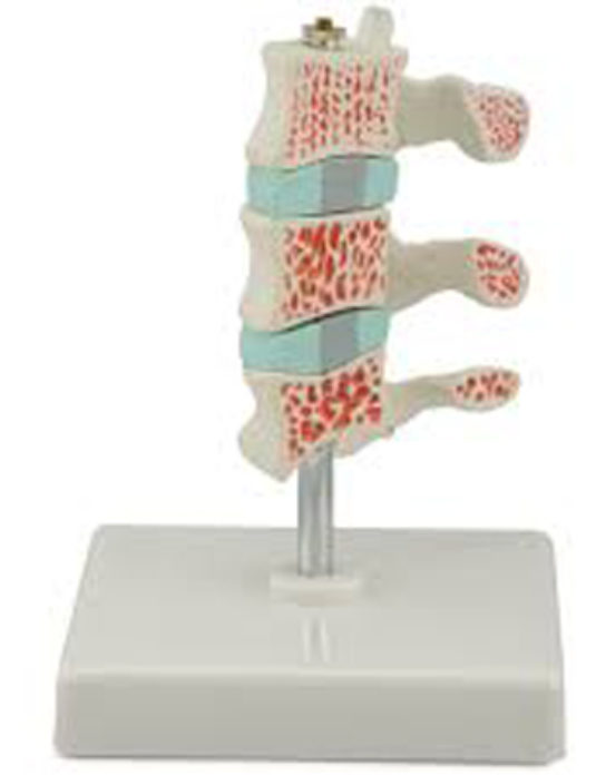 Advanced-Osteoporosis-Model