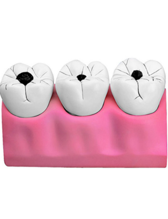 Dental-Caries-Model