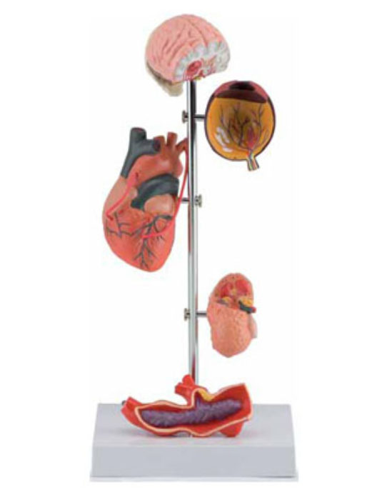Effects-Of-Hypertension