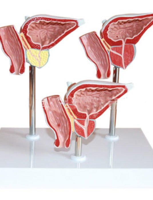 Normal-&-Diseased-Prostate-Gland