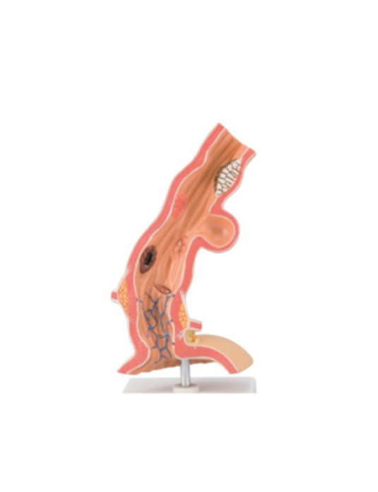 Pathological-Model-Of-Esophagus