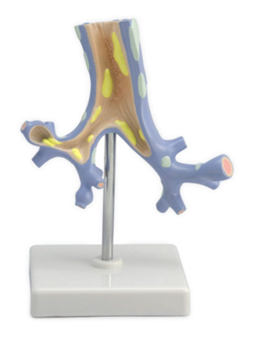 Pathological-Model-Of-The-Bronchi