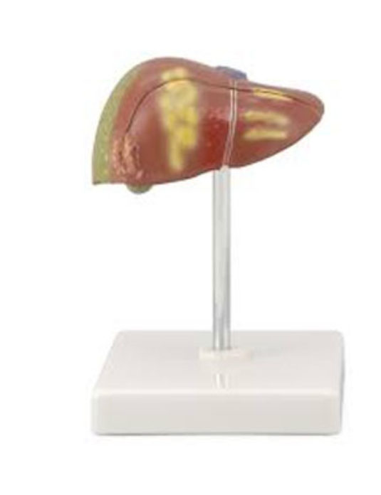 Pathological-Model-Of-The-Liver