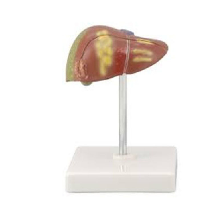 Pathological Thyroid Model Gland Model Hypothyroendocrine System Thyroid Pathological Model Classroom Teaching Supplies
