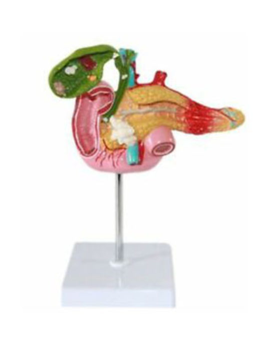 Pathological-Model-Of-The-Pancreas